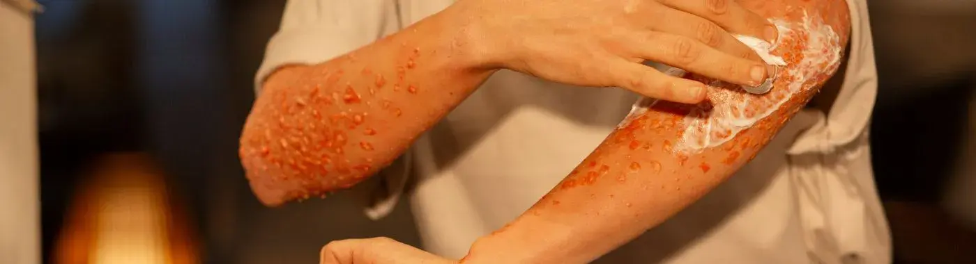 Meningococcal Disease - Causes, Symptoms, Diagnosis, Treatment, and Prevention