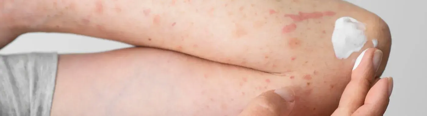 Meningococcemia - Causes, Symptoms, Diagnosis, Treatment, and Prevention