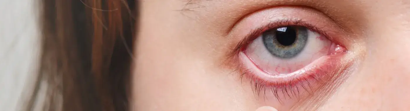 Ocular Rosacea - Causes, Symptoms, Diagnosis, Treatment, and Prevention