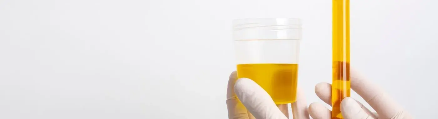 Orthostatic Proteinuria - Causes, Symptoms, Diagnosis, Treatment, and Prevention