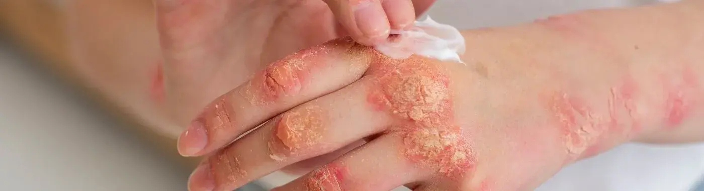 Plaque Psoriasis - Causes, Symptoms, Diagnosis, Treatment, and Prevention