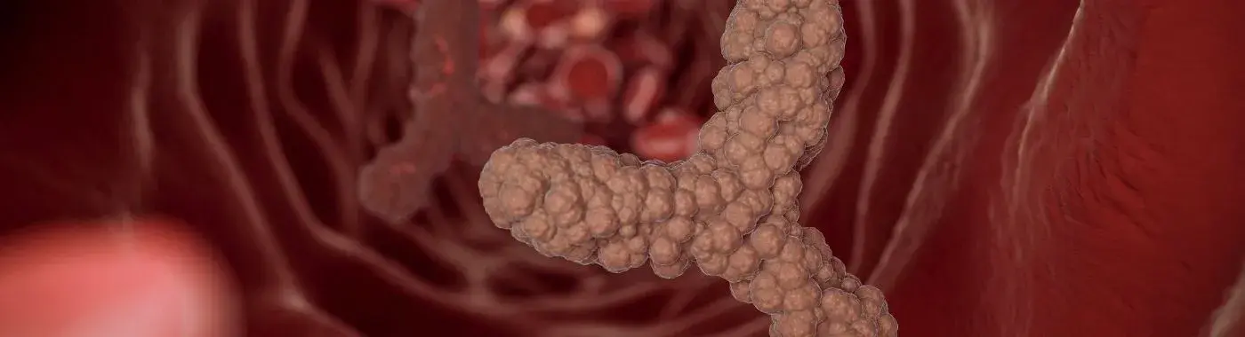 Portal Vein Thrombosis - Causes, Symptoms, Diagnosis, Treatment, and Prevention