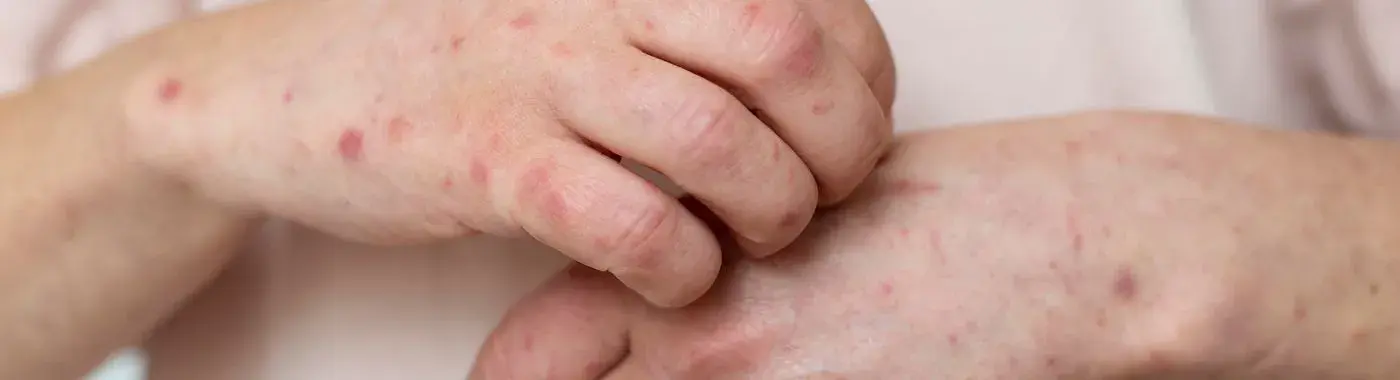 Prurigo Nodularis - Causes, Symptoms, Diagnosis, Treatment, and Prevention