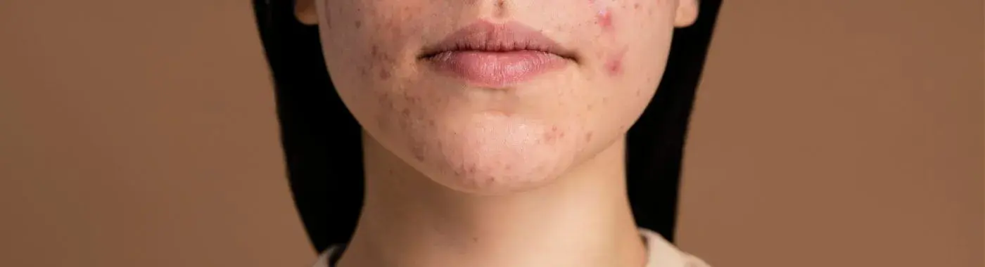 Psoriasis On The Face - Causes, Symptoms, Diagnosis, Treatment, and Prevention
