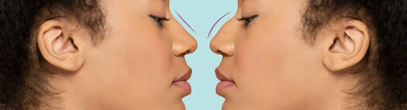 Saddle Nose - Causes, Symptoms, Diagnosis, Treatment, and Prevention