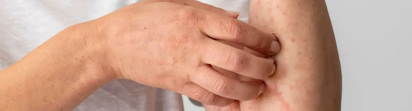 Serum Sickness - Causes, Symptoms, Diagnosis, Treatment, and Prevention