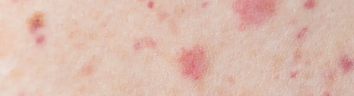 Sézary Syndrome - Early Signs, Risk Factors, Diagnosis, and Treatment Explained