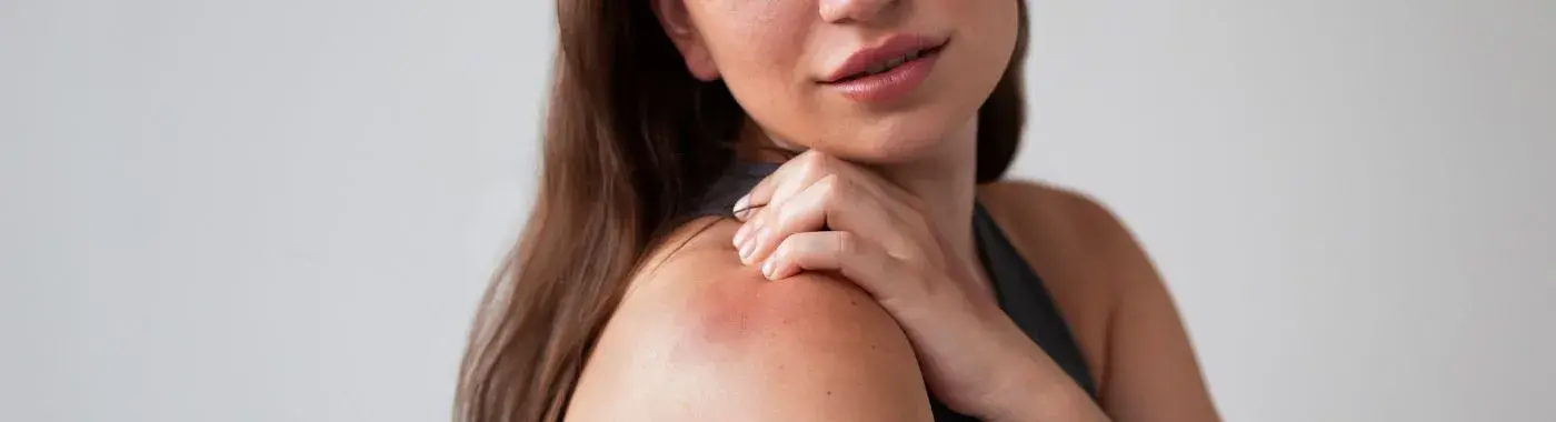 Stevens-Johnson Syndrome - Causes, Symptoms, Diagnosis, Treatment, and Prevention