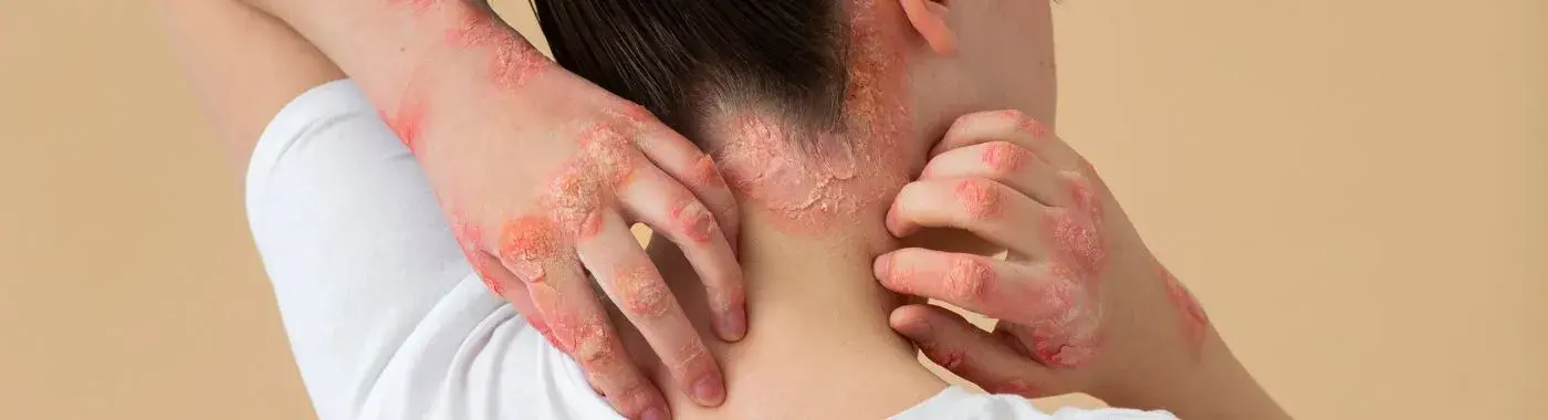 T-Cell Lymphoma - Early Signs, Risk Factors, Diagnosis, and Treatment Explained