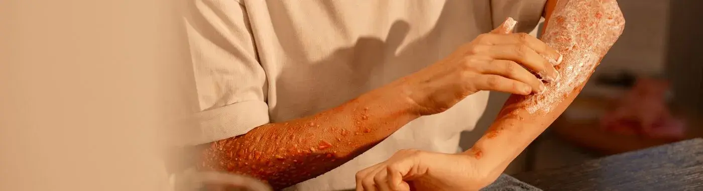 Tattoo Infection - Causes, Symptoms, Diagnosis, Treatment, and Prevention