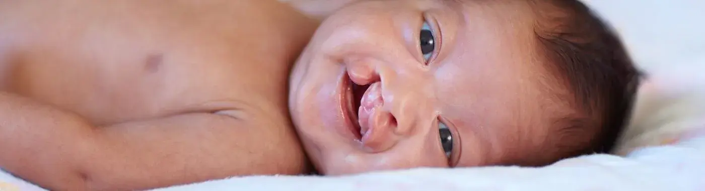 Van Der Woude Syndrome - Causes, Symptoms, Diagnosis, Treatment, and Prevention