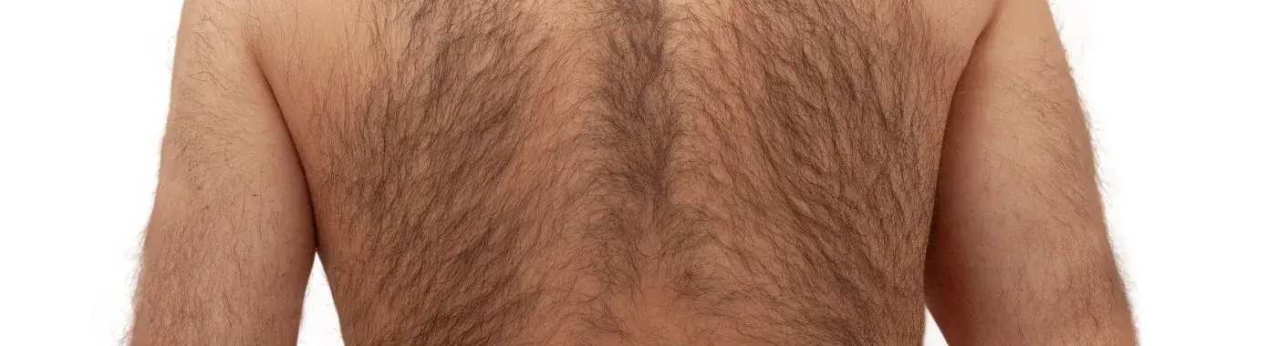 Virilization - Causes, Symptoms, Diagnosis, Treatment, and Prevention