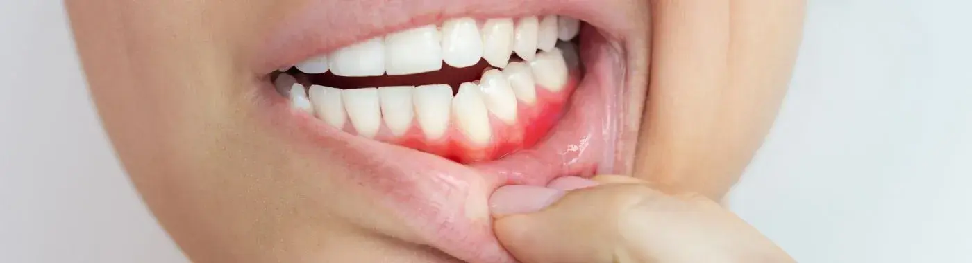 Bleeding gums