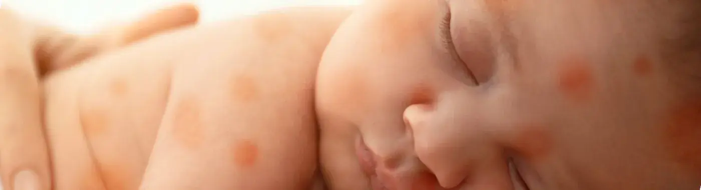 Blueberry muffin rash