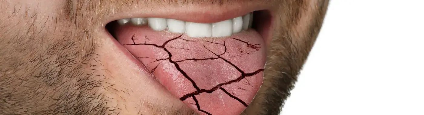 Diabetes and dry mouth