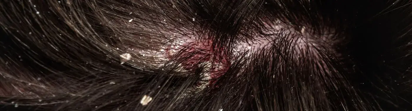 Dry scalp