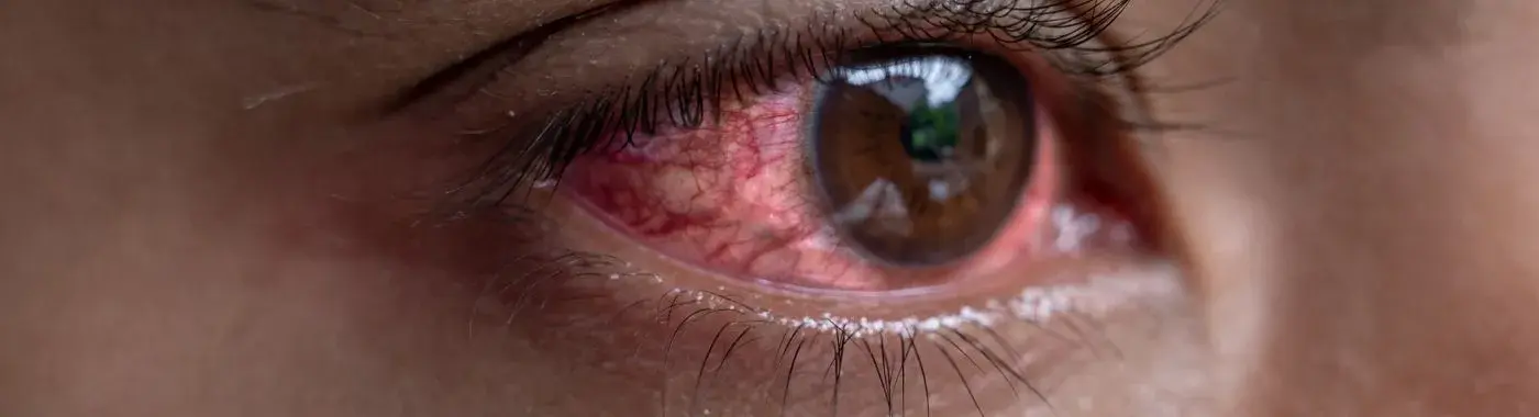 eye-irritation