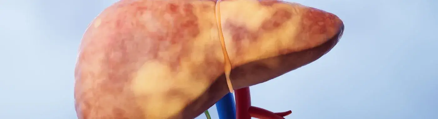 Hepatomegaly