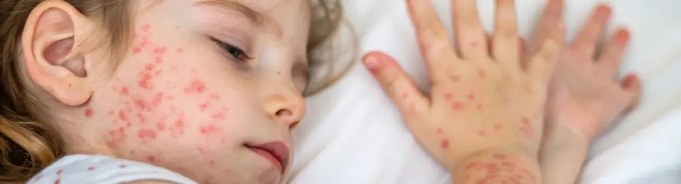 Hives in children