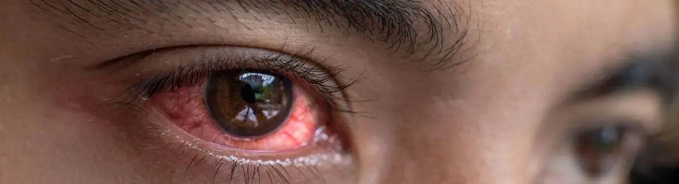 Red eye