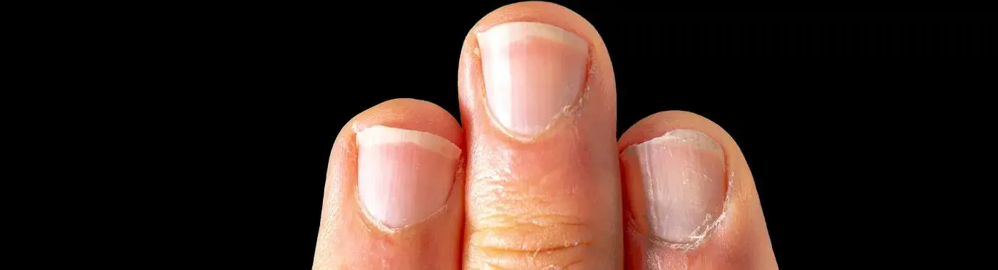 Ridges in nails