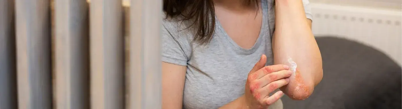 Second-degree burn