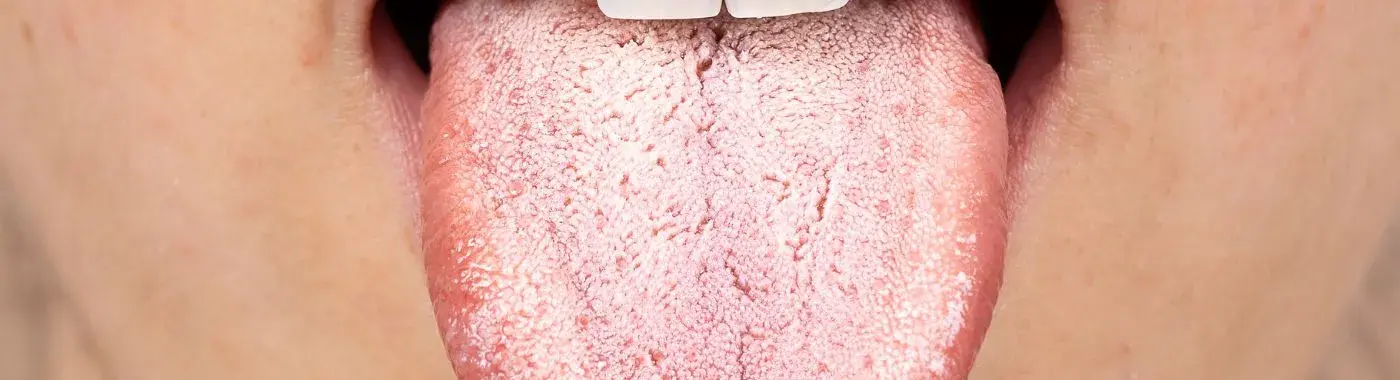 White tongue