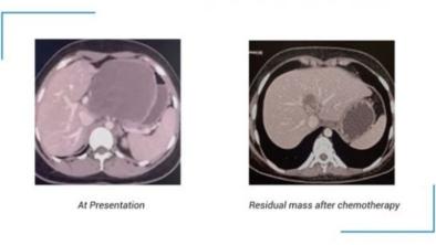  Tumor Sel Bulat Kecil Desmoplastik Ligamen Hepatoduodonal – Entitas Langka 