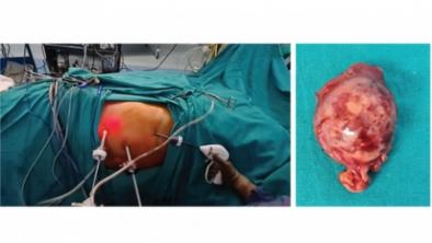  Nefrektomi Parsial Laparoskopik untuk Tumor Ginjal Hialar Kanan yang Rumit pada Pasien Jantung Risiko Sangat Tinggi Sambil Menyelamatkan Ginjal 