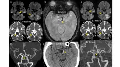  Neurointervensi pada Stroke Iskemik Akut 