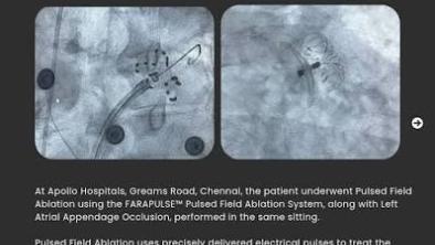  Team at Apollo Hospitals Chennai Combines PFA and LAA Closure for Patient with Atrial Fibrillation and High Bleeding Risk  