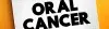 Lip and Oral Cavity Cancer - Early Signs, Risk Factors, Diagnosis, and Treatment Explained