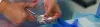 AV Fistula Surgery - Procedures, Preparation, Cost, and Recovery