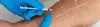 Bioresorbable Vascular Scaffold - Procedures, Preparation, Cost, and Recovery