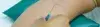 Central Venous Catheterization (CVC) - Procedures, Preparation, Cost, and Recovery