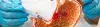 Esophagectomy - Procedures, Preparation, Cost, and Recovery