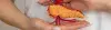 Pancreas Transplant - Procedures, Preparation, Cost, and Recovery