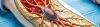 Thrombectomy - Procedures, Preparation, Cost, and Recovery