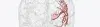 Arteriovenous Malformation (AVM) - Cost, Indications, Preparation, Risks, and Recovery