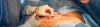 What is Aortic Root Surgery