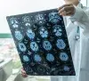 Brain Stroke thumbnail
