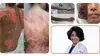 25 gadus vecs, Pirmo reizi diagnosticēts, Pemphigus Vulgaris pacients veiksmīgi pārvaldīts
