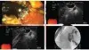 អាយុ 70 ឆ្នាំបានទទួលជោគជ័យ EUS Guided Biliary Drainage Choledochoduodenostomy (CDS)
