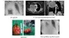 Hemi-Clamshell Approach for Large Complex Intrathoracic Tumors