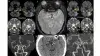 Neurointervention dans l'accident vasculaire cérébral ischémique aigu