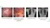 ការគ្រប់គ្រងដោយជោគជ័យនៃ Catamenial Pneumothorax ( Thoracic Endometriosis )